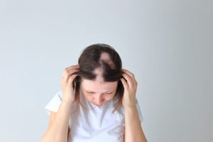 Alopesi üzerinde bağırsak mikrobiyomunun etkisi